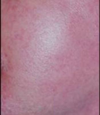 Telangiectasia after laser treatment