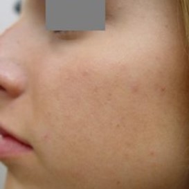 Acne laser treatment - After