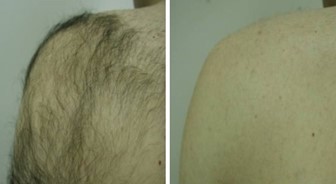 Before and after image of hair removal