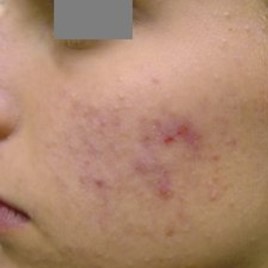 Acne laser treatment - Before